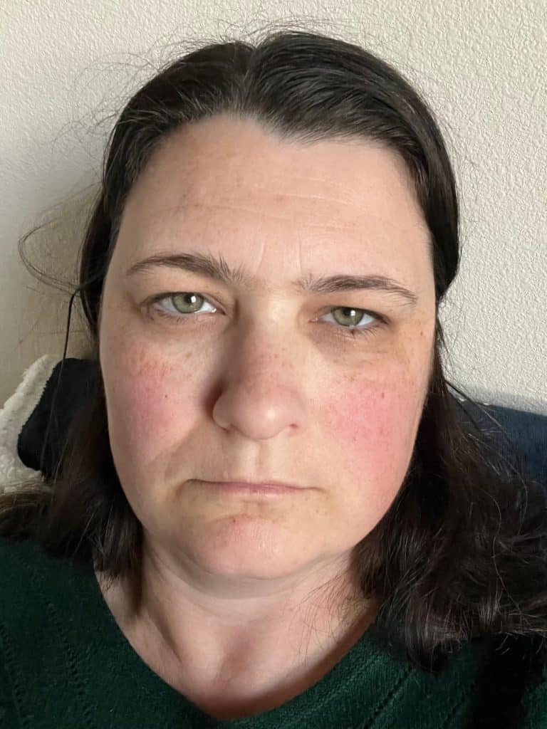 Tired woman. Can TMJ cause migraines?